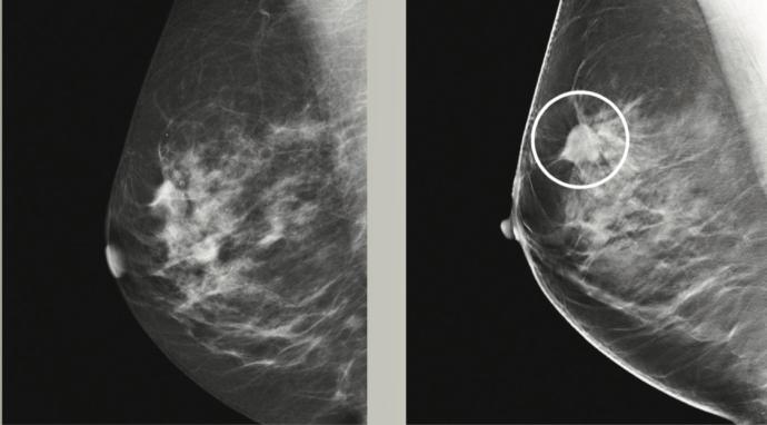 Girls, who dont or dont plan on getting mammogram when of the appropriate age, why dont you get them?