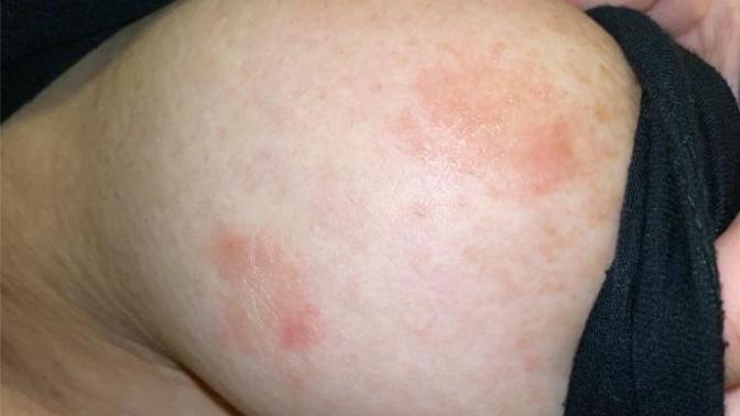 Any idea what these patches may be?