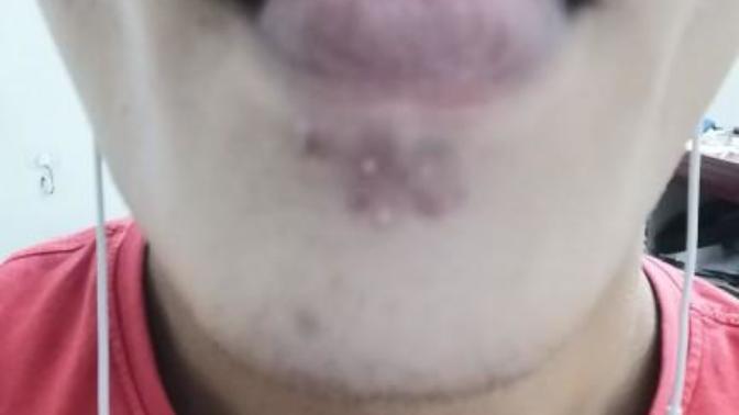 I got chin acne, Just that, no acne elsewhere , but lots of chin acne, why is this happening?