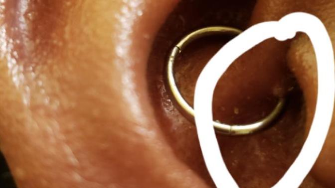 Has anyone else experienced the dreaded irritation bump on a daithpiercing?