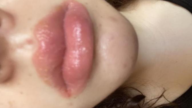 What to do about my extremely dehydrated lips?