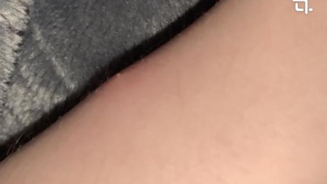 What kind of bug bite is this?