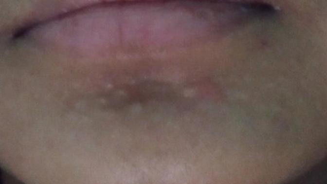 Help! how did you treat your acne scar?