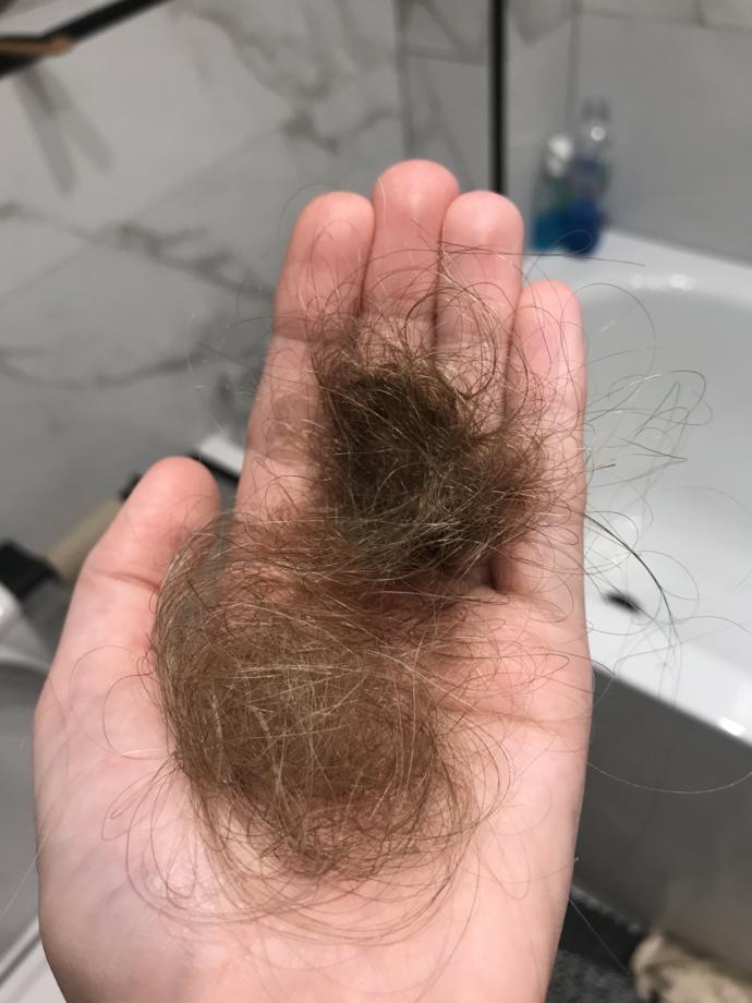 Is this a normal amount of hair to loose?