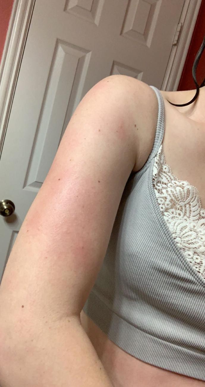 How to soothe rash caused by Pantene hair product?