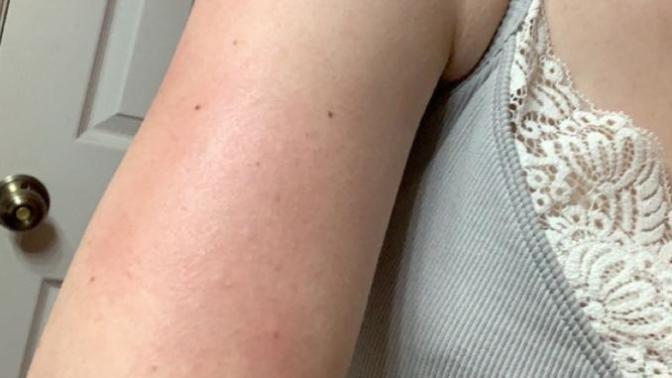 How to soothe rash caused by Pantene hair product?