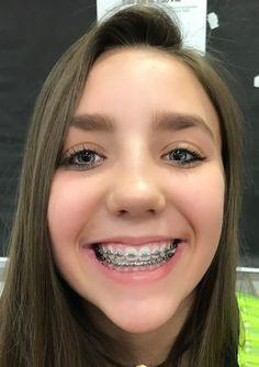 Would you date someone who wears braces?