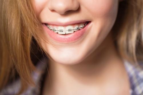 Would you date someone who wears braces?