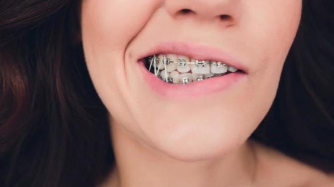 Does anyone have any tips on braces, I just got rubber bands today?