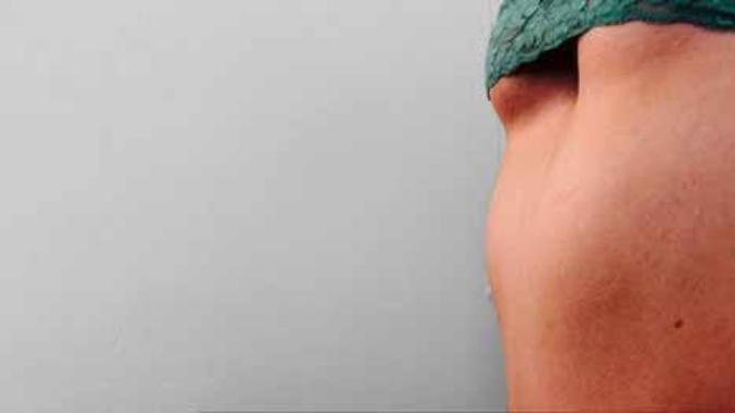 Boob job to mask chest deformity?