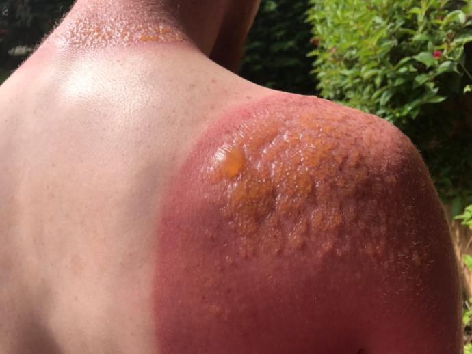 Worst sunburn you've ever had?