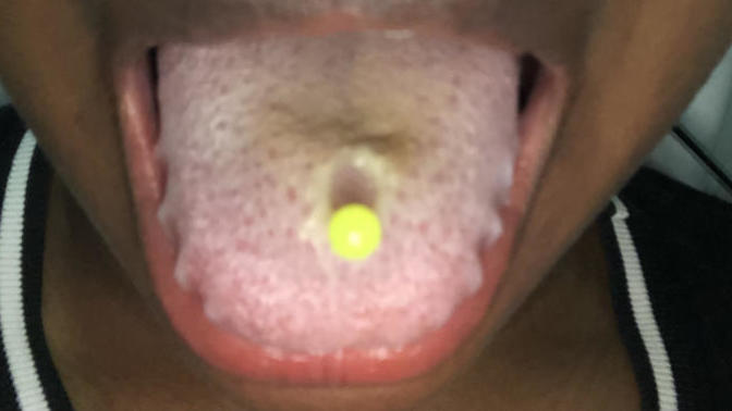 Tongue piercing issues?