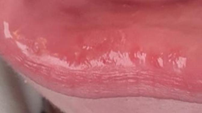 Help tiny red bumps on my lips what are they?