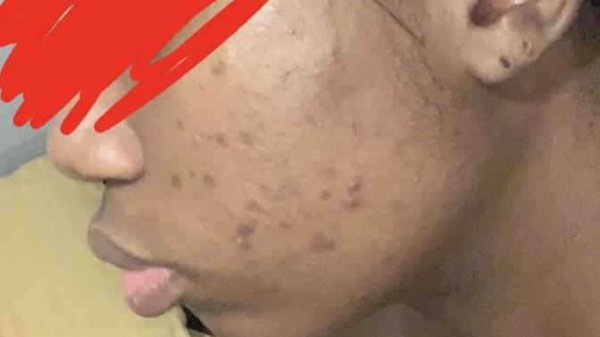 How do I clear this acne and scars?