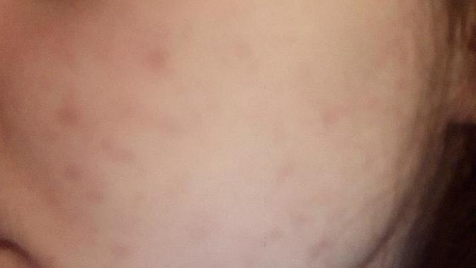 Are these freckles or acnes?