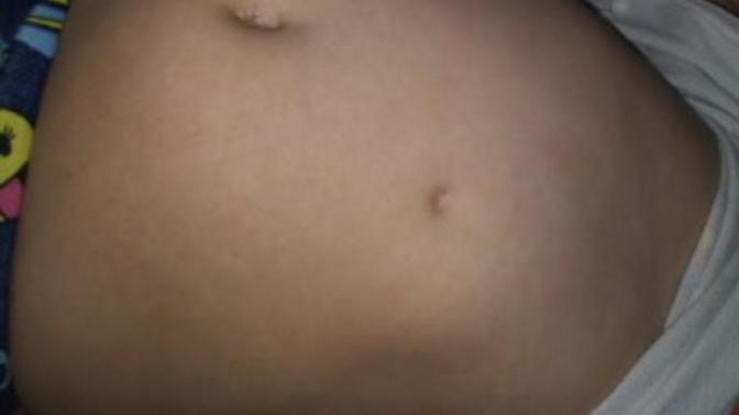 How do you guys feel about a feeding tube scar?