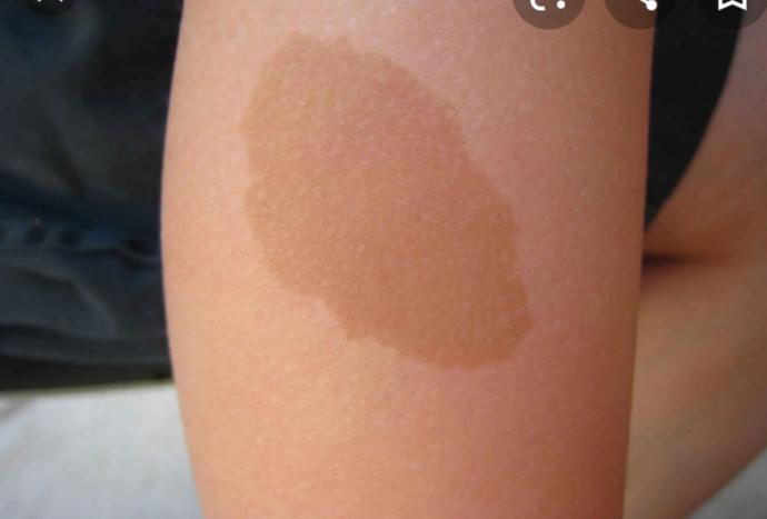 Do you have such a birth-mole?