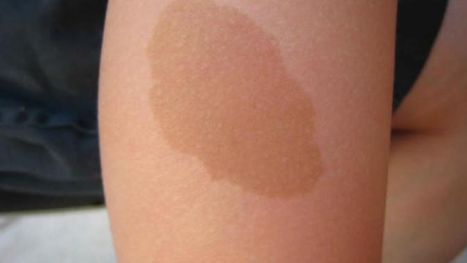 Do you have such a birth-mole?