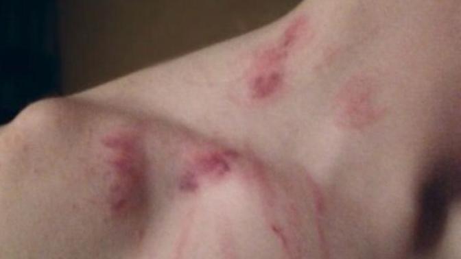 Guys, would you let your girlfriend give you hickeys?