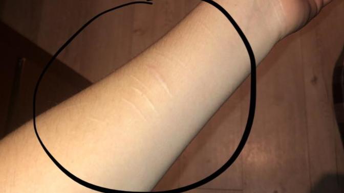 *Trigger warning * Would you date a girl with a self-harm scar on her arm?