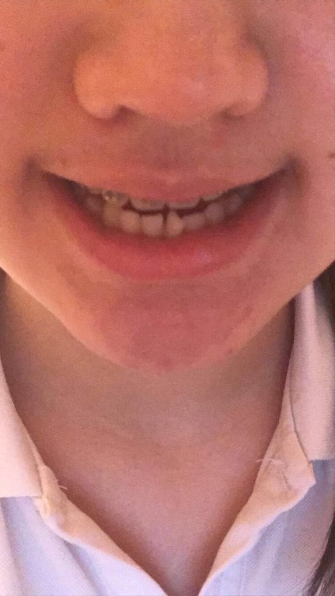 Do you think crooked teeth are ugly?