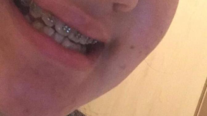 Do you think crooked teeth are ugly?