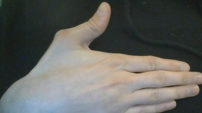 Does anyone know why my thumbs are like this?