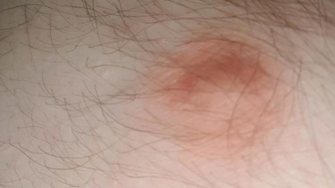 Had a random lump / spot appear on my chest it's been here for a bit now can't find much online its painless etc can anyone tell me what it is?