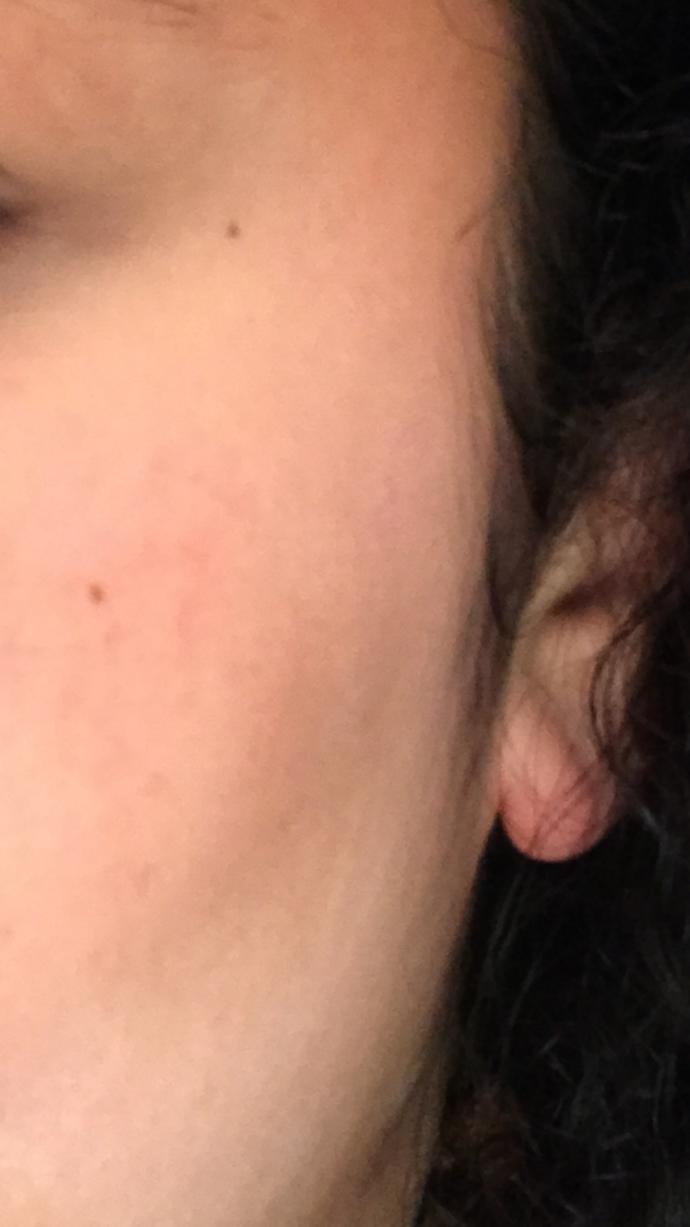 How do I get rid of these small beauty marks on my face?