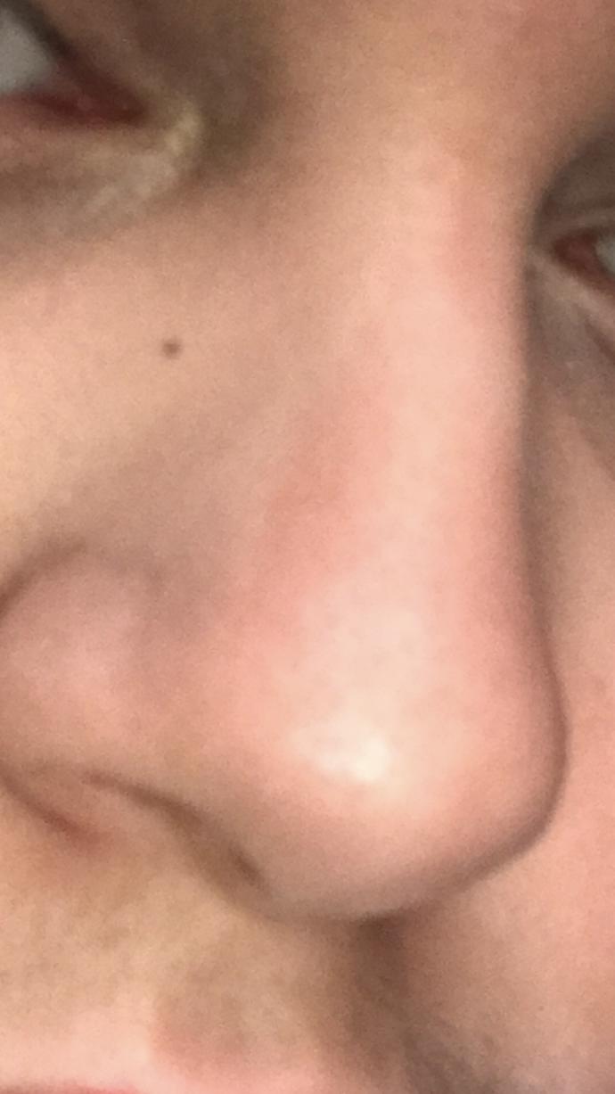 How do I get rid of these small beauty marks on my face?