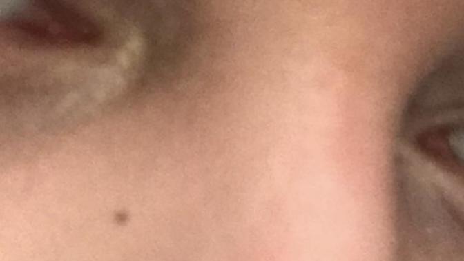 How do I get rid of these small beauty marks on my face?