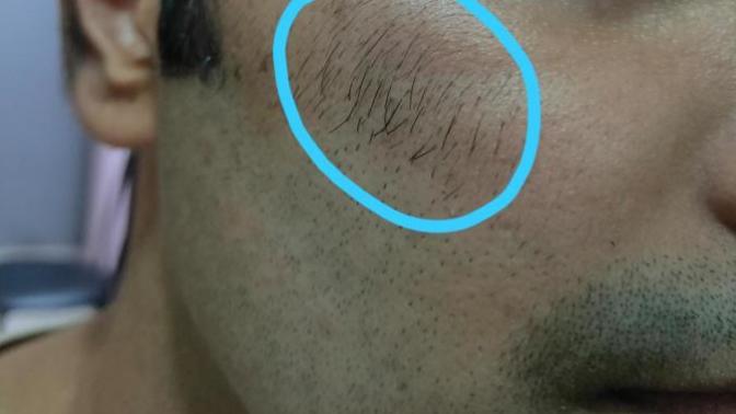 What should I do with my unwanted facial hair (pic in description)?