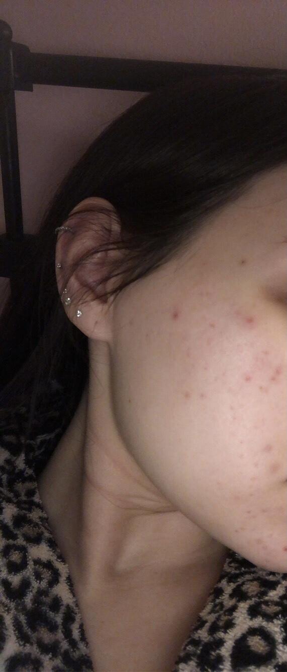 Does acne on a girl bother you? would this make you any less attracted to her?
