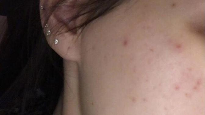 Does acne on a girl bother you? would this make you any less attracted to her?