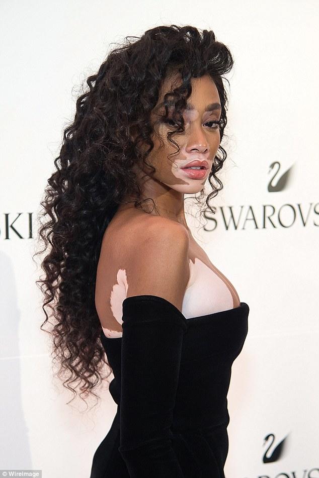 Would you marry someone with vitiligo?