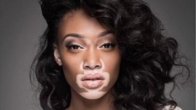 Would you marry someone with vitiligo?