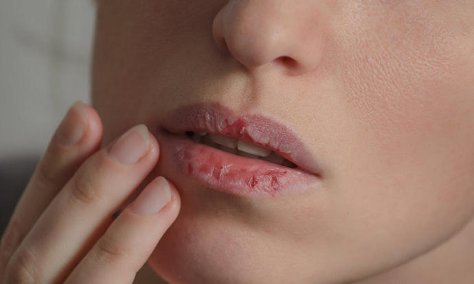 Are crusty (chapped lips) a turn off?