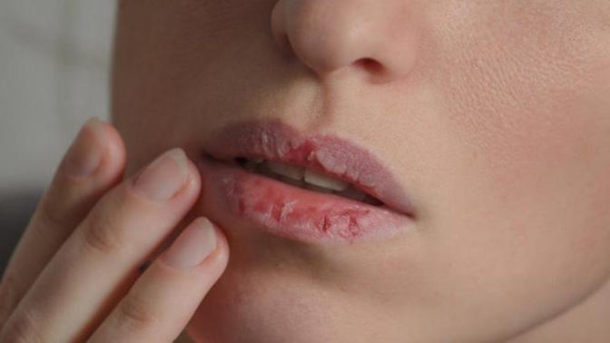 Are crusty (chapped lips) a turn off?