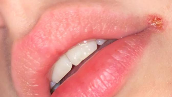 Is this dry skin or a cold sore and how do I get rid of it?