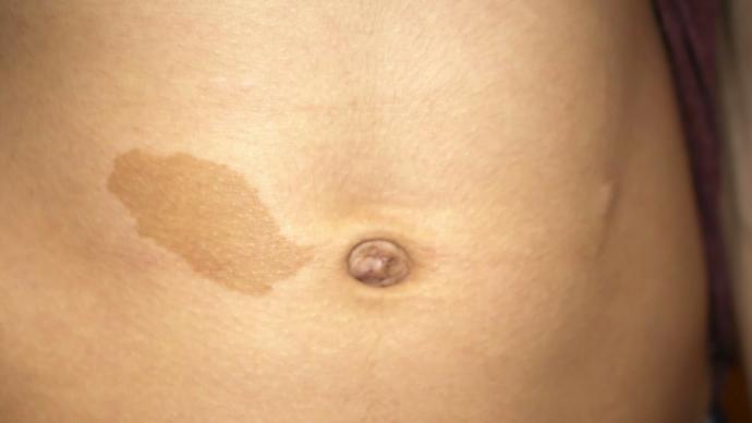 Do you love your Birthmark?
