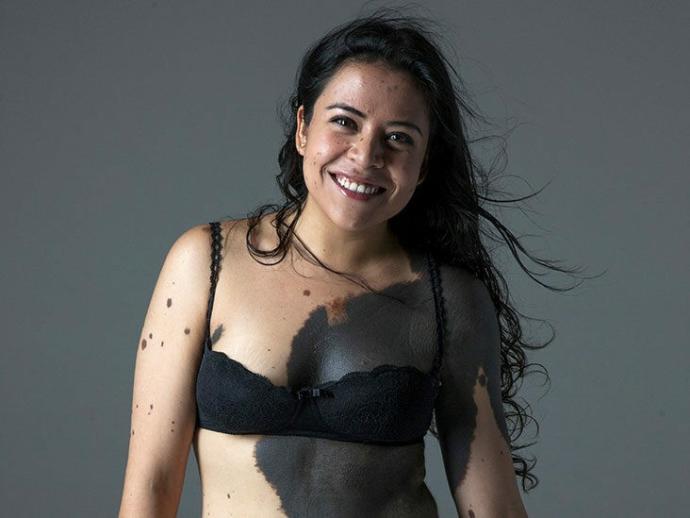 Do you love your Birthmark?