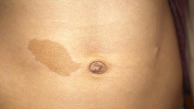 Do you love your Birthmark?