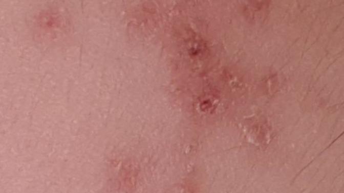 Will I have scars?