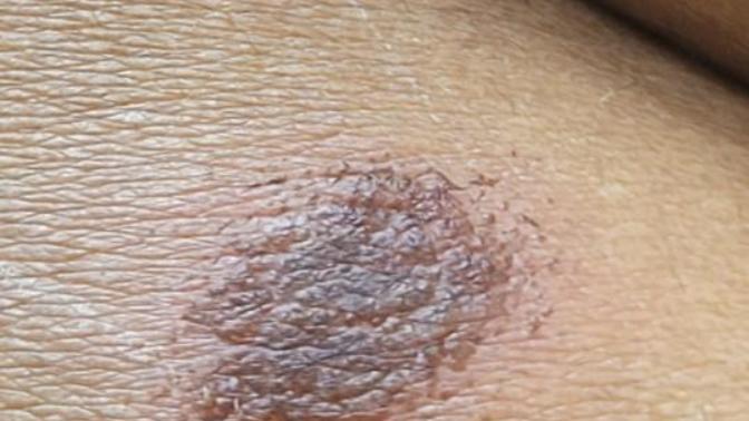 What is this scar on my back?