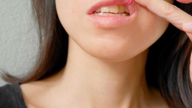 When is the last time you had a canker sore?
