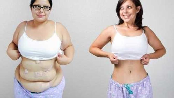 Do you think weight loss surgery is the “easy” way out?