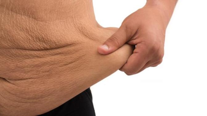 Would you do weight loss surgery?