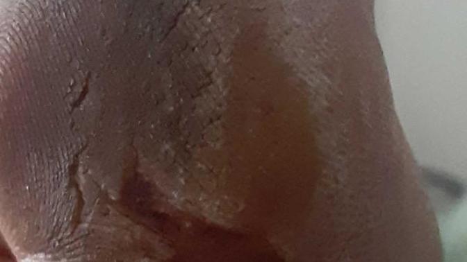 Is there a easy way to get rid of this hard skin on my foot that I got from walking barefoot?