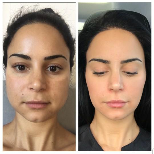 For anyone who has gotten masseter botox, how do you like your results? Any negative effects?