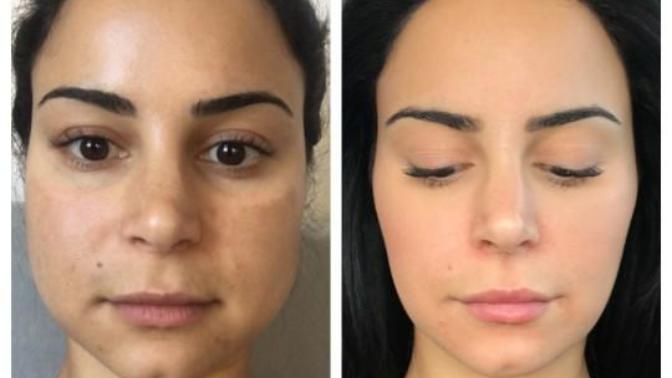 For anyone who has gotten masseter botox, how do you like your results? Any negative effects?